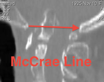 SMO McCrae Line CT